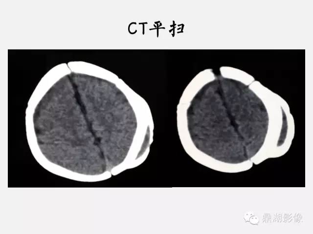【病例】颅骨骨膜下血肿1例