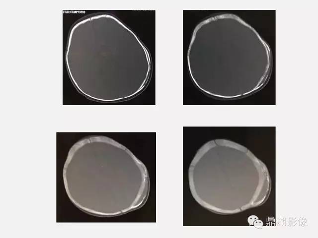 【病例】颅骨骨膜下血肿1例