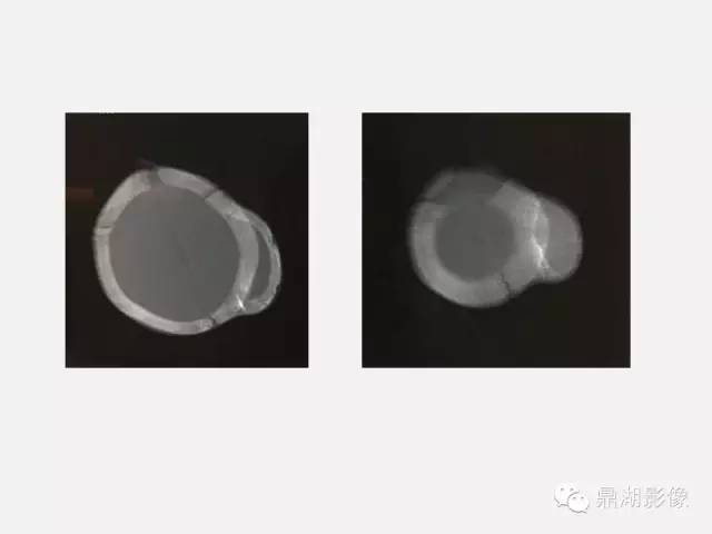 【病例】颅骨骨膜下血肿1例