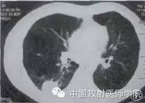 【病例】肺炎型肺癌1例CT影像特点