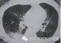 【病例】肺炎型肺癌1例CT影像特点