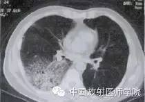 【病例】肺炎型肺癌1例CT影像特点