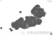【病例】肺炎型肺癌1例CT影像特点