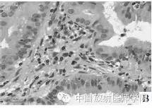 【病例】肺炎型肺癌1例CT影像特点