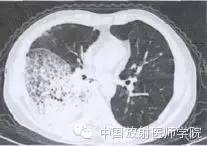 【病例】肺炎型肺癌1例CT影像特点