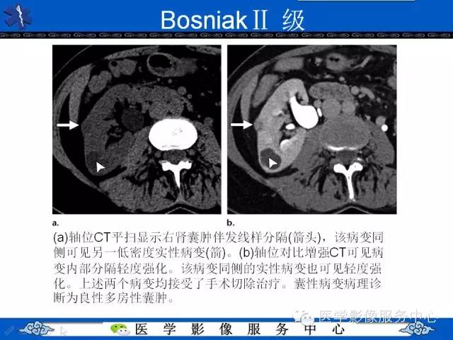 【PPT】肾囊性病变的CT和MRI影像学表现
