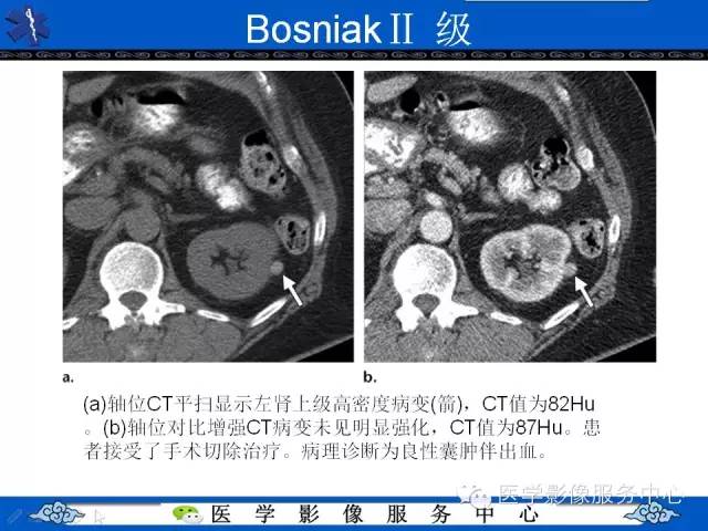 【PPT】肾囊性病变的CT和MRI影像学表现