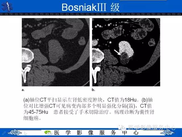 【PPT】肾囊性病变的CT和MRI影像学表现