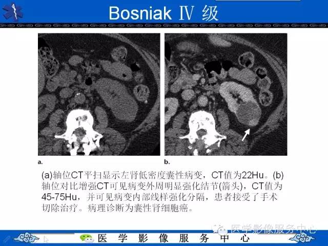 【PPT】肾囊性病变的CT和MRI影像学表现