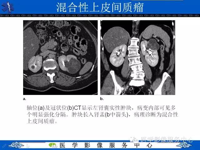 【PPT】肾囊性病变的CT和MRI影像学表现
