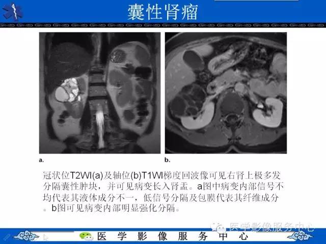 【PPT】肾囊性病变的CT和MRI影像学表现
