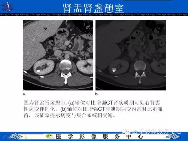 【PPT】肾囊性病变的CT和MRI影像学表现
