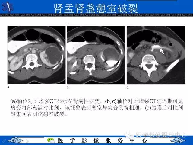 【PPT】肾囊性病变的CT和MRI影像学表现