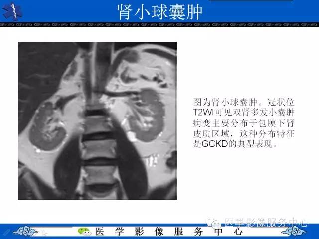 【PPT】肾囊性病变的CT和MRI影像学表现
