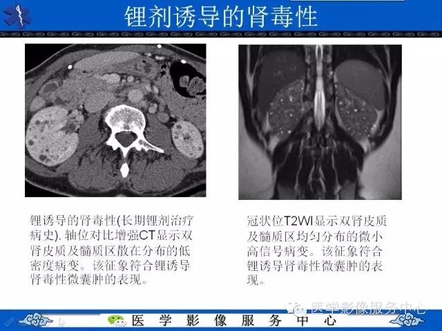 【PPT】肾囊性病变的CT和MRI影像学表现