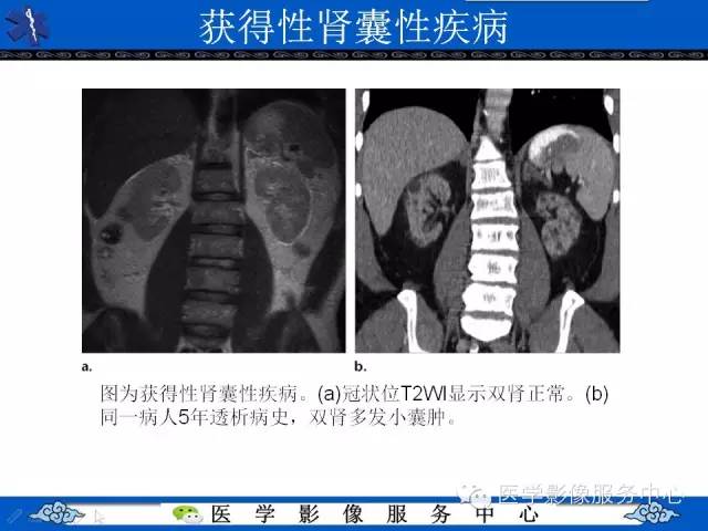 【PPT】肾囊性病变的CT和MRI影像学表现