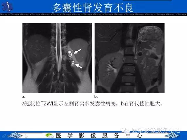 【PPT】肾囊性病变的CT和MRI影像学表现