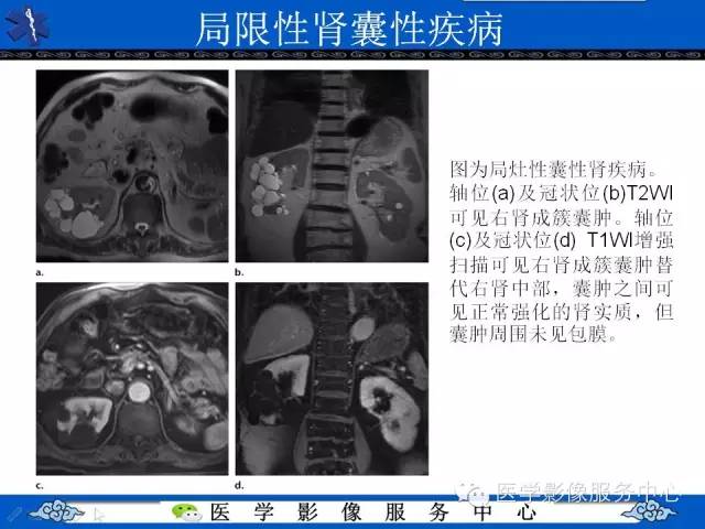 【PPT】肾囊性病变的CT和MRI影像学表现