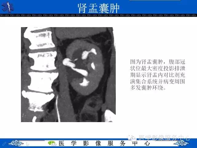 【PPT】肾囊性病变的CT和MRI影像学表现