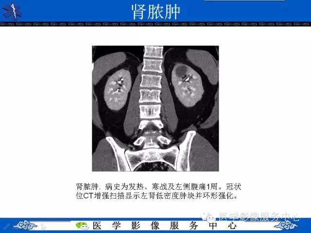 【PPT】肾囊性病变的CT和MRI影像学表现