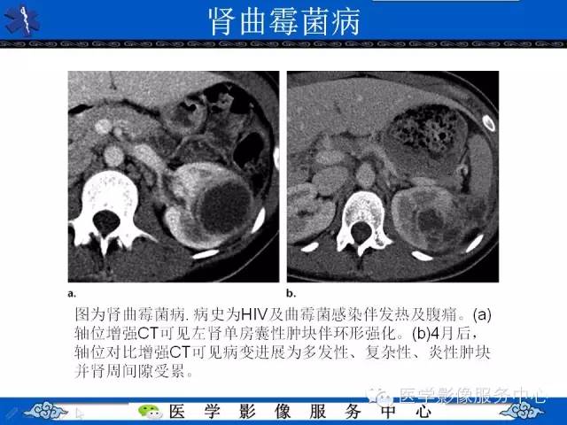 【PPT】肾囊性病变的CT和MRI影像学表现