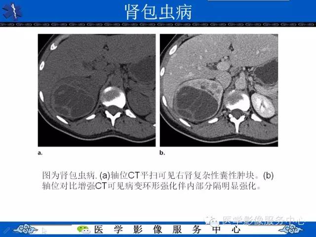 【PPT】肾囊性病变的CT和MRI影像学表现