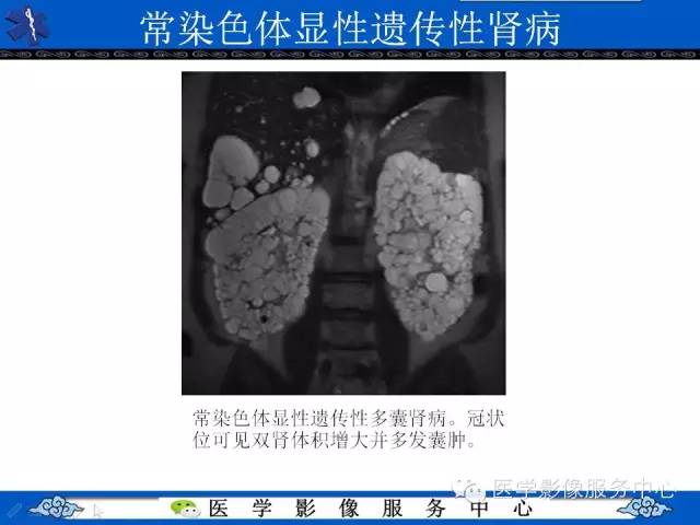 【PPT】肾囊性病变的CT和MRI影像学表现