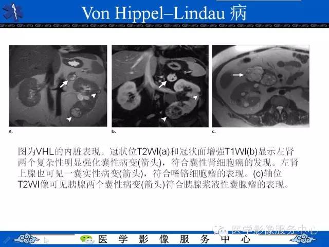 【PPT】肾囊性病变的CT和MRI影像学表现
