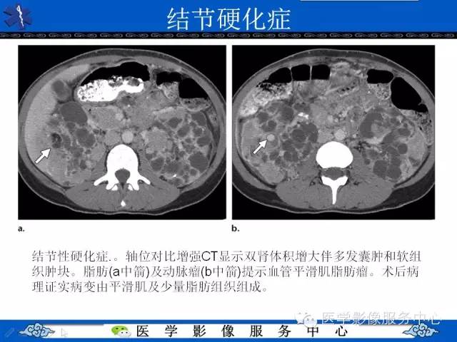 【PPT】肾囊性病变的CT和MRI影像学表现