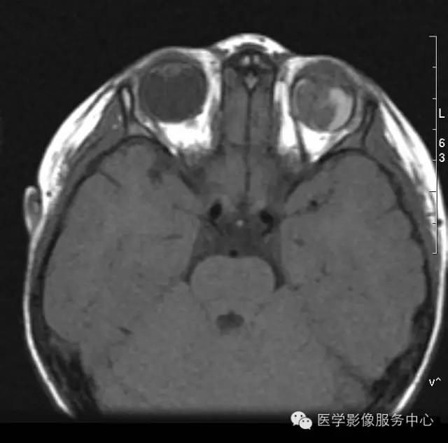 【病例】原始永存玻璃体增生症1例MR影像表现