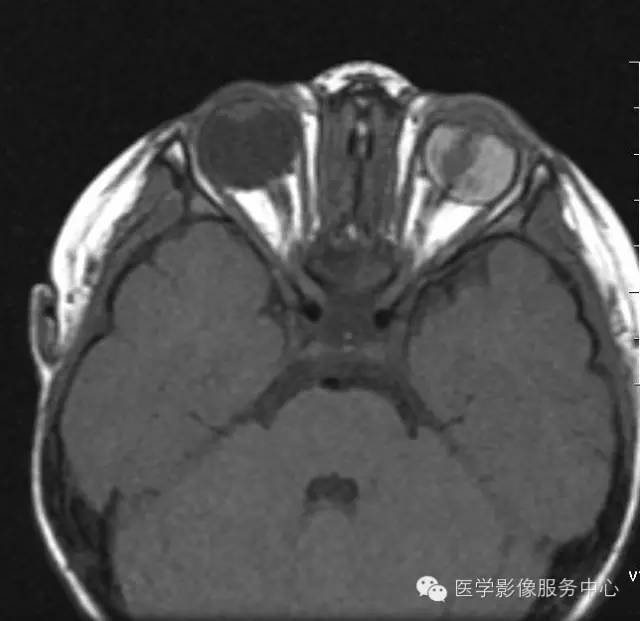 【病例】原始永存玻璃体增生症1例MR影像表现 【病例】原始永存玻璃体增生症1例MR影像表现