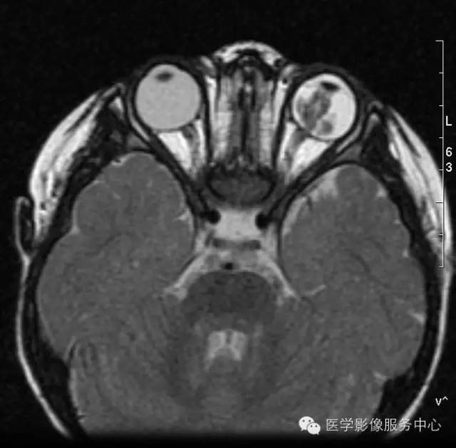 【病例】原始永存玻璃体增生症1例MR影像表现 【病例】原始永存玻璃体增生症1例MR影像表现