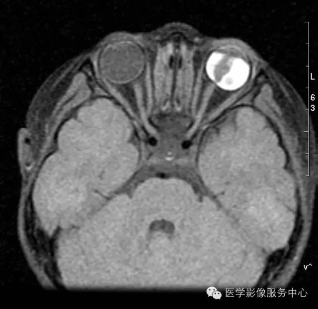 【病例】原始永存玻璃体增生症1例MR影像表现 【病例】原始永存玻璃体增生症1例MR影像表现