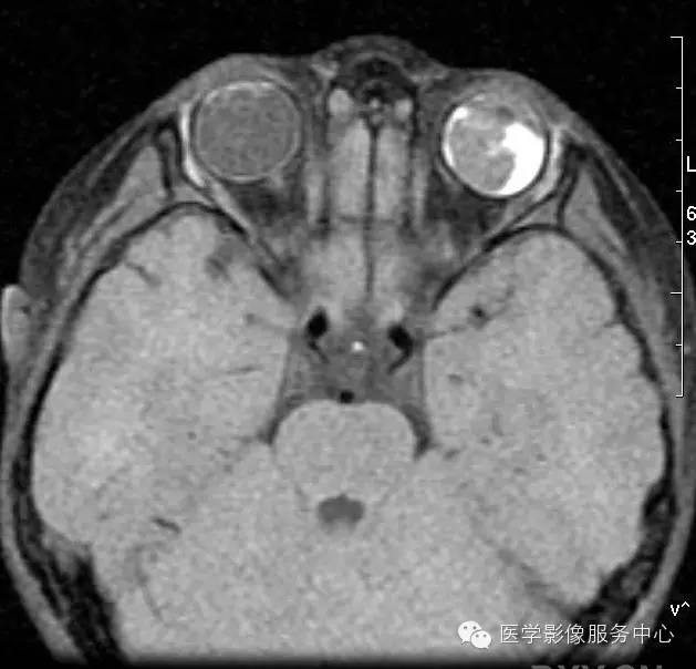 【病例】原始永存玻璃体增生症1例MR影像表现 【病例】原始永存玻璃体增生症1例MR影像表现