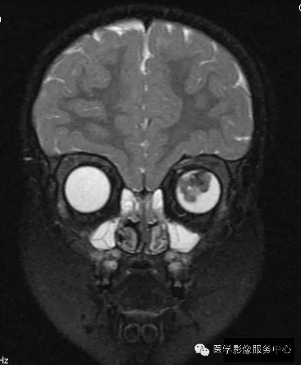 【病例】原始永存玻璃体增生症1例MR影像表现 【病例】原始永存玻璃体增生症1例MR影像表现