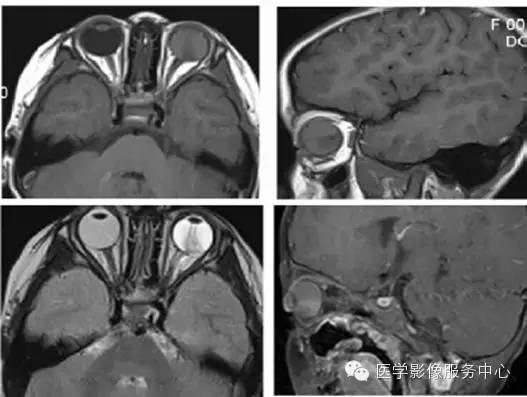 【病例】原始永存玻璃体增生症1例MR影像表现 【病例】原始永存玻璃体增生症1例MR影像表现