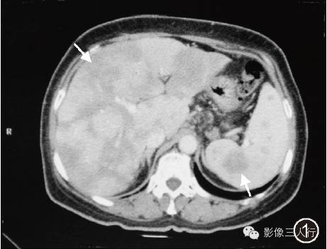 【病例】肝脏结节病一例影像表现