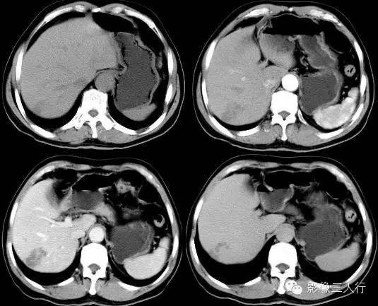 肝脏炎性假瘤 Inflammatory Pseudotumor,IPT 肝脏炎性假瘤 Inflammatory Pseudotumor,IPT