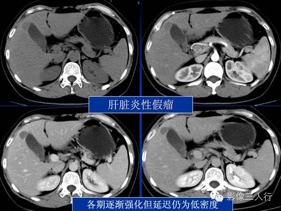肝脏炎性假瘤 Inflammatory Pseudotumor,IPT 肝脏炎性假瘤 Inflammatory Pseudotumor,IPT
