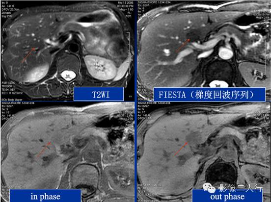 肝脏炎性假瘤 Inflammatory Pseudotumor,IPT 肝脏炎性假瘤 Inflammatory Pseudotumor,IPT