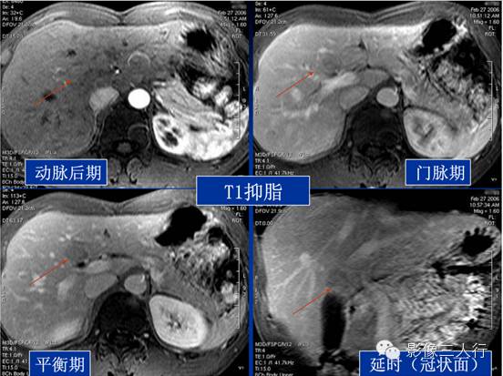 肝脏炎性假瘤 Inflammatory Pseudotumor,IPT 肝脏炎性假瘤 Inflammatory Pseudotumor,IPT