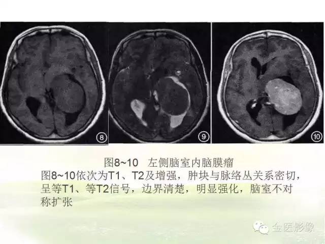 【PPT】脑室内脑膜瘤的MRI诊断