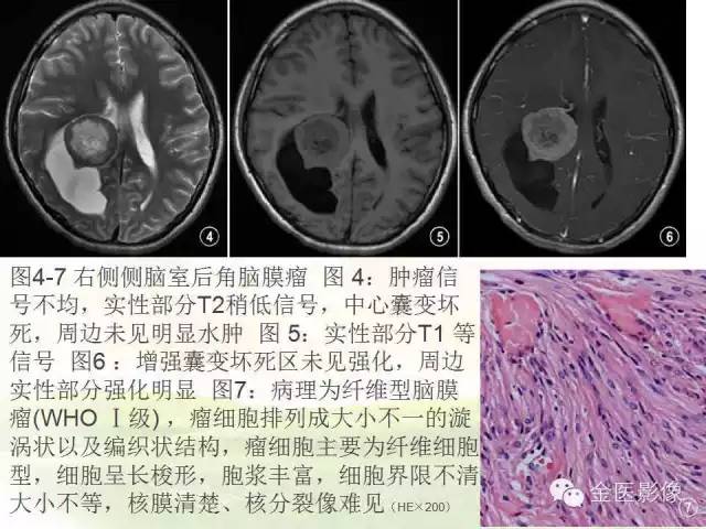 【PPT】脑室内脑膜瘤的MRI诊断
