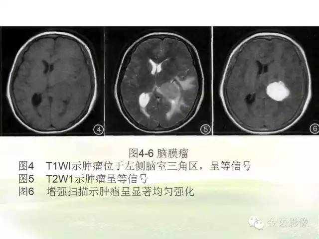 【PPT】脑室内脑膜瘤的MRI诊断