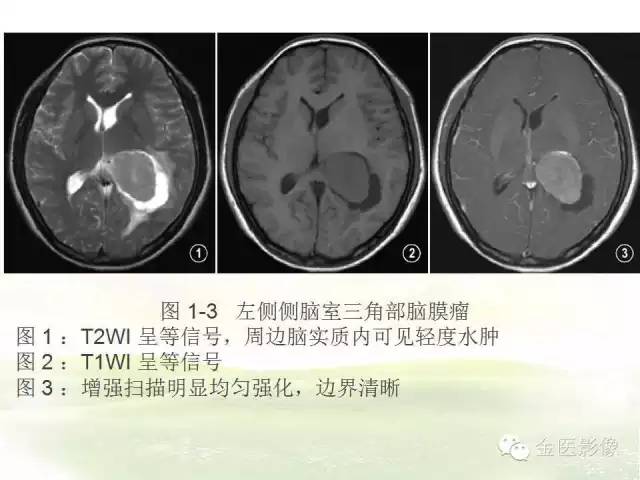 【PPT】脑室内脑膜瘤的MRI诊断