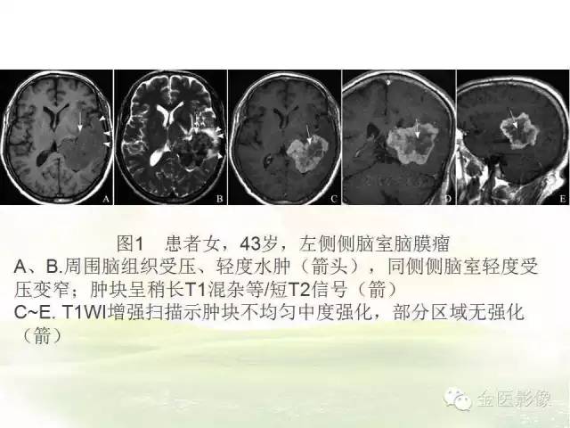 【PPT】脑室内脑膜瘤的MRI诊断