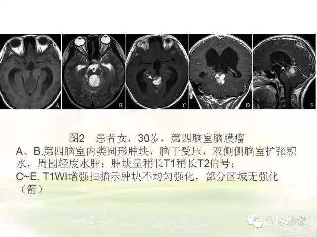 【PPT】脑室内脑膜瘤的MRI诊断