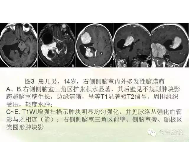 【PPT】脑室内脑膜瘤的MRI诊断