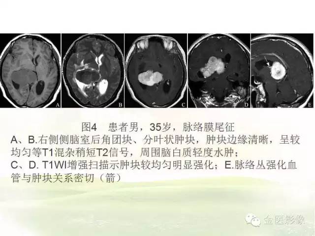 【PPT】脑室内脑膜瘤的MRI诊断