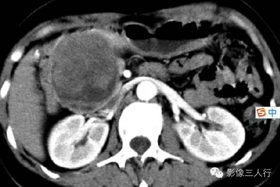 胰腺实性假乳头状瘤Solid Pseudopaillary Neoplasm 胰腺实性假乳头状瘤Solid Pseudopaillary Neoplasm